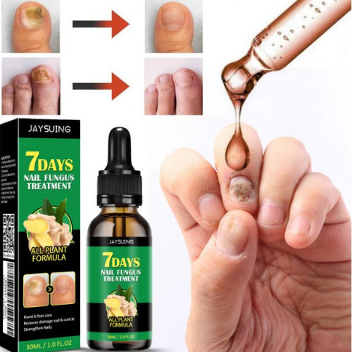 Tratamiento para Hongos en Uñas 30ml – Jaysuing